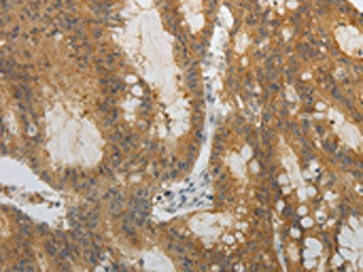 The image on the left is immunohistochemistry of paraffin-embedded Human colon cancer tissue using CSB-PA385632(OCLN Antibody) at dilution 1/10, on the right is treated with fusion protein. (Original magnification: ×200)