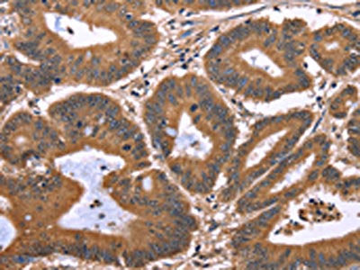 The image on the left is immunohistochemistry of paraffin-embedded Human colon cancer tissue using CSB-PA386522(TDP2 Antibody) at dilution 1/40, on the right is treated with synthetic peptide. (Original magnification: ×200)