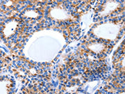 The image on the left is immunohistochemistry of paraffin-embedded Human thyroid cancer tissue using CSB-PA389898(LAMA5 Antibody) at dilution 1/8, on the right is treated with synthetic peptide. (Original magnification: ×200)