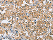 The image on the left is immunohistochemistry of paraffin-embedded Human thyroid cancer tissue using CSB-PA390581(BCL10 Antibody) at dilution 1/40, on the right is treated with fusion protein. (Original magnification: ×200)