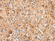 The image on the left is immunohistochemistry of paraffin-embedded Human liver cancer tissue using CSB-PA390632(AQP7 Antibody) at dilution 1/20, on the right is treated with synthetic peptide. (Original magnification: ×200)