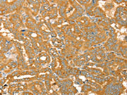 The image on the left is immunohistochemistry of paraffin-embedded Human thyroid cancer tissue using CSB-PA391533(PTPN22 Antibody) at dilution 1/30, on the right is treated with fusion protein. (Original magnification: ×200)