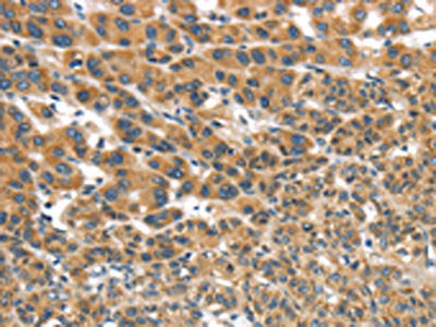 The image on the left is immunohistochemistry of paraffin-embedded Human liver cancer tissue using CSB-PA391541(UBTD2 Antibody) at dilution 1/35, on the right is treated with synthetic peptide. (Original magnification: ×200)