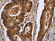 The image on the left is immunohistochemistry of paraffin-embedded Human colon cancer tissue using CSB-PA399518(EXTL3 Antibody) at dilution 1/30, on the right is treated with fusion protein. (Original magnification: ×200)
