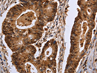 The image on the left is immunohistochemistry of paraffin-embedded Human colon cancer tissue using CSB-PA399518(EXTL3 Antibody) at dilution 1/30, on the right is treated with fusion protein. (Original magnification: ×200)