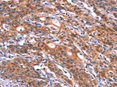The image on the left is immunohistochemistry of paraffin-embedded Human gastic cancer tissue using CSB-PA400855(FEM1A Antibody) at dilution 1/20, on the right is treated with synthetic peptide. (Original magnification: ×200)