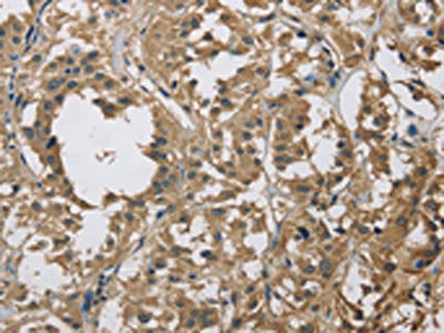 The image on the left is immunohistochemistry of paraffin-embedded Human thyroid cancer tissue using CSB-PA401715(DSG2 Antibody) at dilution 1/70, on the right is treated with fusion protein. (Original magnification: ×200)