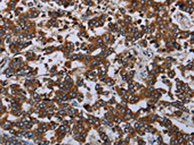 The image on the left is immunohistochemistry of paraffin-embedded Human liver cancer tissue using CSB-PA403881(AVEN Antibody) at dilution 1/20, on the right is treated with synthetic peptide. (Original magnification: ×200)