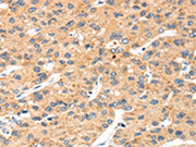 The image on the left is immunohistochemistry of paraffin-embedded Human liver cancer tissue using CSB-PA404751(SLC8B1 Antibody) at dilution 1/20, on the right is treated with synthetic peptide. (Original magnification: ×200)
