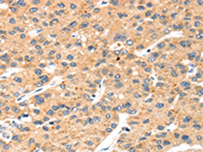 The image on the left is immunohistochemistry of paraffin-embedded Human liver cancer tissue using CSB-PA404751(SLC8B1 Antibody) at dilution 1/20, on the right is treated with synthetic peptide. (Original magnification: ×200)