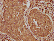 IHC image of CSB-PA406235LA01HU diluted at 1:100 and staining in paraffin-embedded human cervical cancer performed on a Leica BondTM system. After dewaxing and hydration, antigen retrieval was mediated by high pressure in a citrate buffer (pH 6.0)...