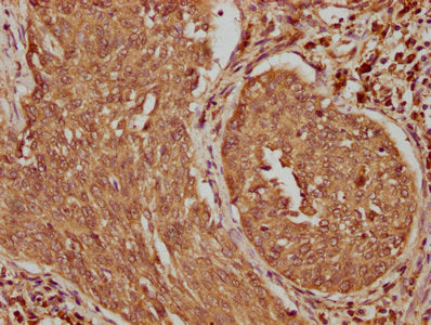 IHC image of CSB-PA406235LA01HU diluted at 1:100 and staining in paraffin-embedded human cervical cancer performed on a Leica BondTM system. After dewaxing and hydration, antigen retrieval was mediated by high pressure in a citrate buffer (pH 6.0)...
