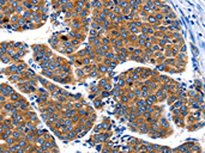 The image on the left is immunohistochemistry of paraffin-embedded Human liver cancer tissue using CSB-PA406823(IGF2BP1 Antibody) at dilution 1/40, on the right is treated with synthetic peptide. (Original magnification: ×200)