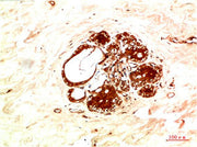 Immunohistochemical analysis of paraffin-embedded Human Breast Carcinoma Tissue using JAK2 Rabbit pAb diluted at 1:200