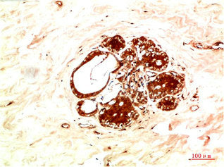 Immunohistochemical analysis of paraffin-embedded Human Breast Carcinoma Tissue using JAK2 Rabbit pAb diluted at 1:200