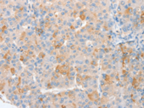 The image on the left is immunohistochemistry of paraffin-embedded Human liver cancer tissue using CSB-PA407491(c-Myc Tag Antibody) at dilution 1/10, on the right is treated with synthetic peptide. (Original magnification: ×200)