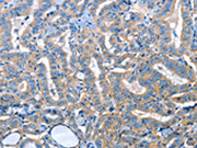 The image on the left is immunohistochemistry of paraffin-embedded Human thyroid cancer tissue using CSB-PA408174(ADH4 Antibody) at dilution 1/25, on the right is treated with fusion protein. (Original magnification: ×200)