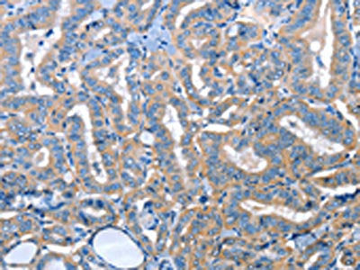 The image on the left is immunohistochemistry of paraffin-embedded Human thyroid cancer tissue using CSB-PA408174(ADH4 Antibody) at dilution 1/25, on the right is treated with fusion protein. (Original magnification: ×200)