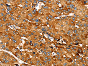 The image on the left is immunohistochemistry of paraffin-embedded Human liver cancer tissue using CSB-PA409215(RNF14 Antibody) at dilution 1/20, on the right is treated with fusion protein. (Original magnification: ×200)