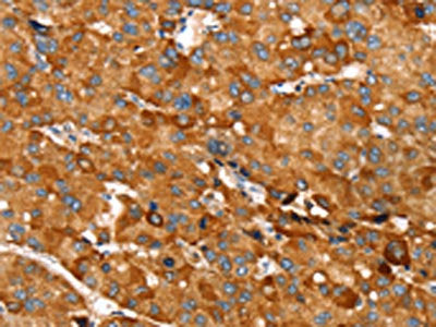 The image on the left is immunohistochemistry of paraffin-embedded Human liver cancer tissue using CSB-PA409215(RNF14 Antibody) at dilution 1/20, on the right is treated with fusion protein. (Original magnification: ×200)