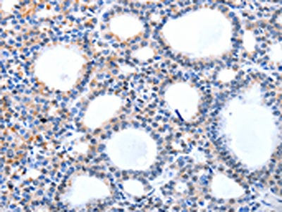The image on the left is immunohistochemistry of paraffin-embedded Human thyroid cancer tissue using CSB-PA409812(HCN1 Antibody) at dilution 1/50, on the right is treated with synthetic peptide. (Original magnification: ×200)