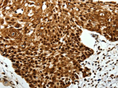 The image on the left is immunohistochemistry of paraffin-embedded Human cervical cancer tissue using CSB-PA409848(SCN1A Antibody) at dilution 1/40, on the right is treated with synthetic peptide. (Original magnification: ×200)