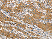 The image on the left is immunohistochemistry of paraffin-embedded Human gastic cancer tissue using CSB-PA409894(ARHGEF7 Antibody) at dilution 1/40, on the right is treated with fusion protein. (Original magnification: ×200)