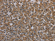 The image on the left is immunohistochemistry of paraffin-embedded Human prostate cancer tissue using CSB-PA410835(MYO7A Antibody) at dilution 1/30, on the right is treated with synthetic peptide. (Original magnification: ×200)