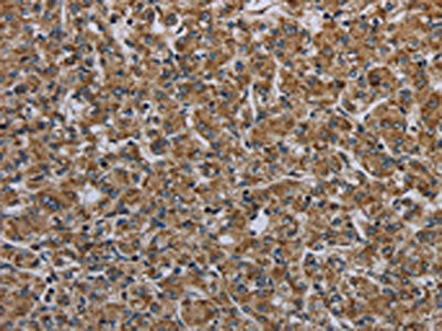 The image on the left is immunohistochemistry of paraffin-embedded Human prostate cancer tissue using CSB-PA410835(MYO7A Antibody) at dilution 1/30, on the right is treated with synthetic peptide. (Original magnification: ×200)