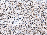 The image is immunohistochemistry of paraffin-embedded Human renal cancer tissue using CSB-PA411017(AQP2 Antibody) at dilution 1/50. (Original magnification: 200)