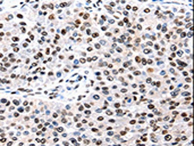 The image is immunohistochemistry of paraffin-embedded Human renal cancer tissue using CSB-PA411017(AQP2 Antibody) at dilution 1/50. (Original magnification: 200)