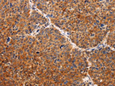 The image on the left is immunohistochemistry of paraffin-embedded Human liver cancer tissue using CSB-PA411062(TIMP2 Antibody) at dilution 1/20, on the right is treated with fusion protein. (Original magnification: ×200)
