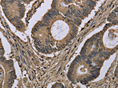 The image on the left is immunohistochemistry of paraffin-embedded Human colon cancer tissue using CSB-PA416372(MYO18B Antibody) at dilution 1/50, on the right is treated with synthetic peptide. (Original magnification: ×200)