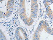 The image on the left is immunohistochemistry of paraffin-embedded Human colon cancer tissue using CSB-PA418151(NTF4 Antibody) at dilution 1/20, on the right is treated with fusion protein. (Original magnification: ×200)