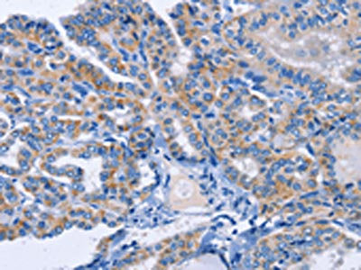 The image on the left is immunohistochemistry of paraffin-embedded Human thyroid cancer tissue using CSB-PA418436(AMACR Antibody) at dilution 1/30, on the right is treated with fusion protein. (Original magnification: ×200)