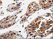 The image is immunohistochemistry of paraffin-embedded Human gastic cancer tissue using CSB-PA419638(RAB41 Antibody) at dilution 1/60. (Original magnification: ×200)