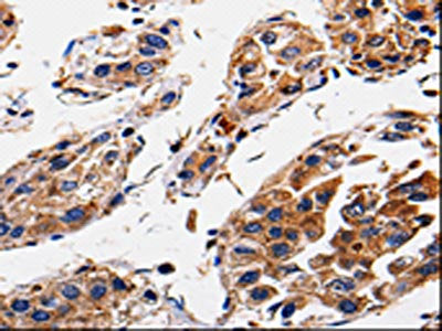 The image is immunohistochemistry of paraffin-embedded Human gastic cancer tissue using CSB-PA419638(RAB41 Antibody) at dilution 1/60. (Original magnification: ×200)