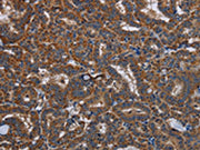 The image on the left is immunohistochemistry of paraffin-embedded Human thyroid cancer tissue using CSB-PA425216(LYN Antibody) at dilution 1/20, on the right is treated with fusion protein. (Original magnification: ×200)