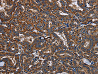 The image on the left is immunohistochemistry of paraffin-embedded Human thyroid cancer tissue using CSB-PA425216(LYN Antibody) at dilution 1/20, on the right is treated with fusion protein. (Original magnification: ×200)