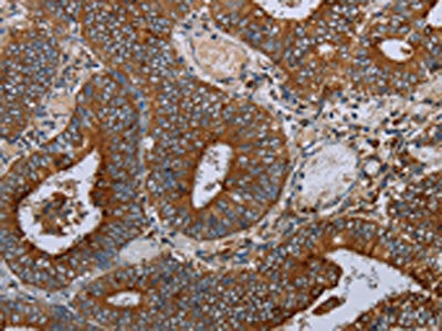 The image on the left is immunohistochemistry of paraffin-embedded Human colon cancer tissue using CSB-PA425800(MAFF Antibody) at dilution 1/20, on the right is treated with synthetic peptide. (Original magnification: ×200)