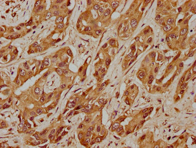 IHC image of CSB-PA427555LA01HU diluted at 1:400 and staining in paraffin-embedded human liver cancer performed on a Leica BondTM system. After dewaxing and hydration, antigen retrieval was mediated by high pressure in a citrate buffer (pH 6.0). S...