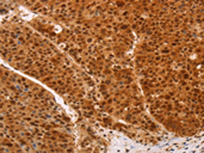 The image on the left is immunohistochemistry of paraffin-embedded Human liver cancer tissue using CSB-PA428601(HEXIM1 Antibody) at dilution 1/65, on the right is treated with fusion protein. (Original magnification: ×200)