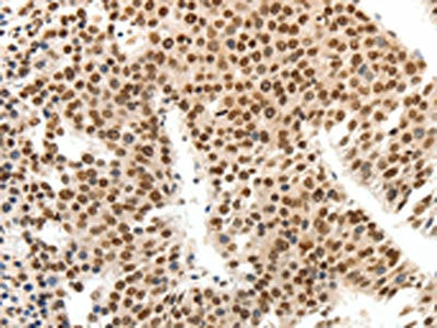 The image on the left is immunohistochemistry of paraffin-embedded Human liver cancer tissue using CSB-PA429423(SIPA1 Antibody) at dilution 1/30, on the right is treated with synthetic peptide. (Original magnification: ×200)