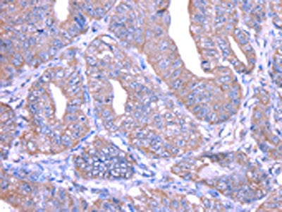 The image on the left is immunohistochemistry of paraffin-embedded Human esophagus cancer tissue using CSB-PA430987(THAP6 Antibody) at dilution 1/25, on the right is treated with fusion protein. (Original magnification: ×200)