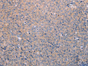The image on the left is immunohistochemistry of paraffin-embedded Human cervical cancer tissue using CSB-PA432470(ANKRD26 Antibody) at dilution 1/25, on the right is treated with synthetic peptide. (Original magnification: ×200)