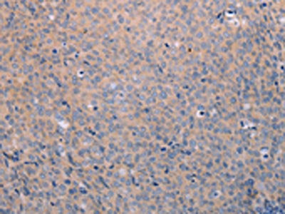 The image on the left is immunohistochemistry of paraffin-embedded Human cervical cancer tissue using CSB-PA432470(ANKRD26 Antibody) at dilution 1/25, on the right is treated with synthetic peptide. (Original magnification: ×200)
