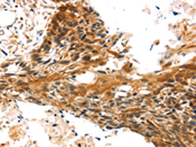 The image on the left is immunohistochemistry of paraffin-embedded Human esophagus cancer tissue using CSB-PA434464(TRIM35 Antibody) at dilution 1/25, on the right is treated with synthetic peptide. (Original magnification: ×200)