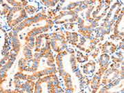 The image on the left is immunohistochemistry of paraffin-embedded Human thyroid cancer tissue using CSB-PA435775(SCNN1A Antibody) at dilution 1/30, on the right is treated with synthetic peptide. (Original magnification: ×200)