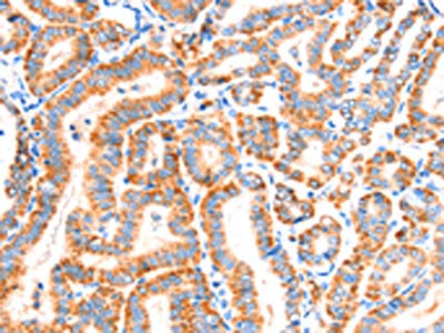 The image on the left is immunohistochemistry of paraffin-embedded Human thyroid cancer tissue using CSB-PA435775(SCNN1A Antibody) at dilution 1/30, on the right is treated with synthetic peptide. (Original magnification: ×200)