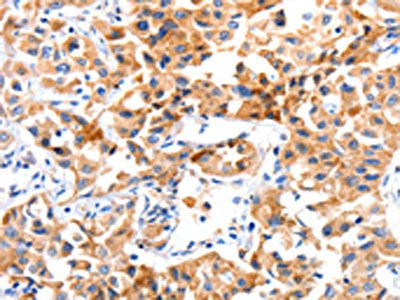 The image on the left is immunohistochemistry of paraffin-embedded Human lung cancer tissue using CSB-PA435870(JAK2 Antibody) at dilution 1/10, on the right is treated with synthetic peptide. (Original magnification: ×200)